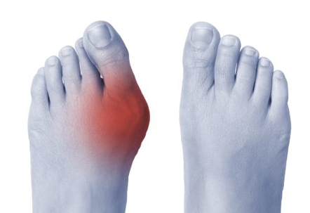 What Is Lapiplasty Surgery? | Bux-Mont Foot & Ankle Care Centers